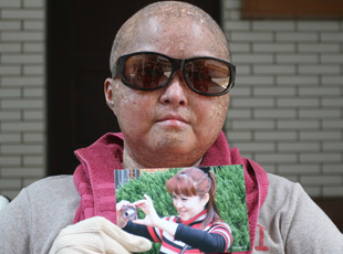 骨髓移植后驟老40歲 臺熟女告醫"還我青春"