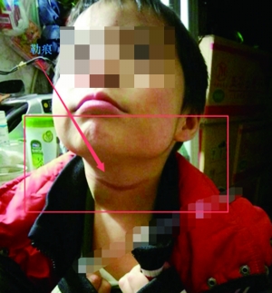 孩子脖子上的傷痕 網絡圖片