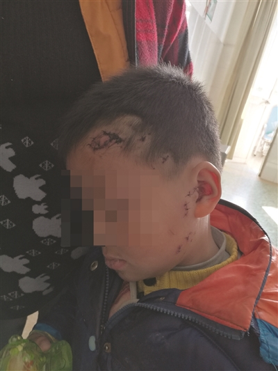 除了下嘴唇,小亮額頭、耳朵也被“二哈”多處咬傷。朱鼎兆 攝